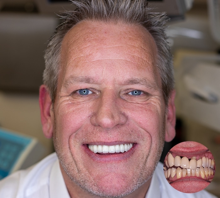 After having Multiple teeth missing treatment