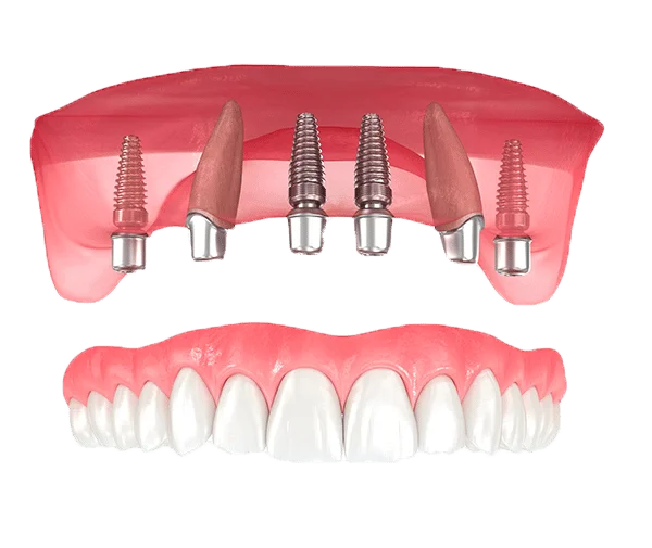 implants All on 4 treatment Birmingham