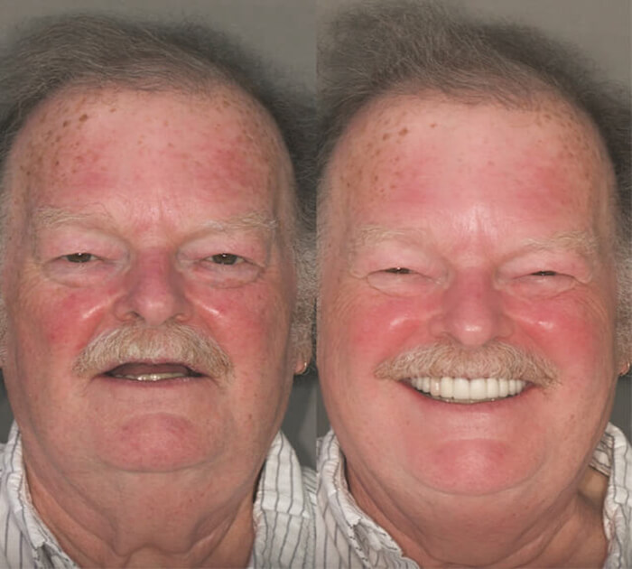 dental-implant-before-after-img