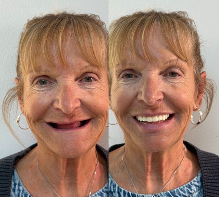 before-after-case-at-dental-implant-centre