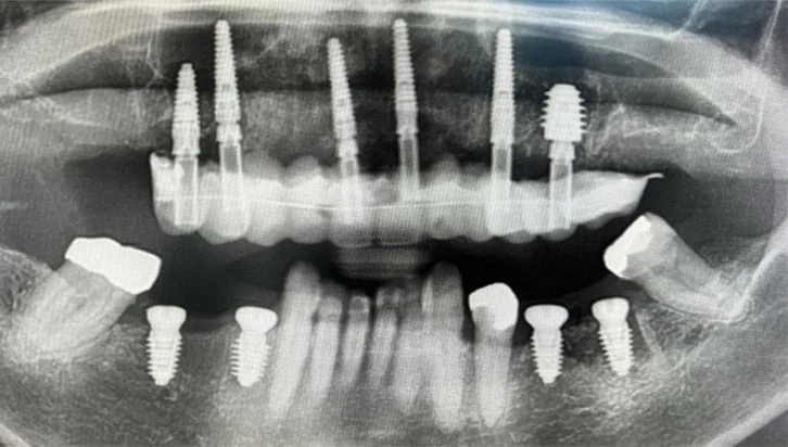 dental-implant-cases-1-after