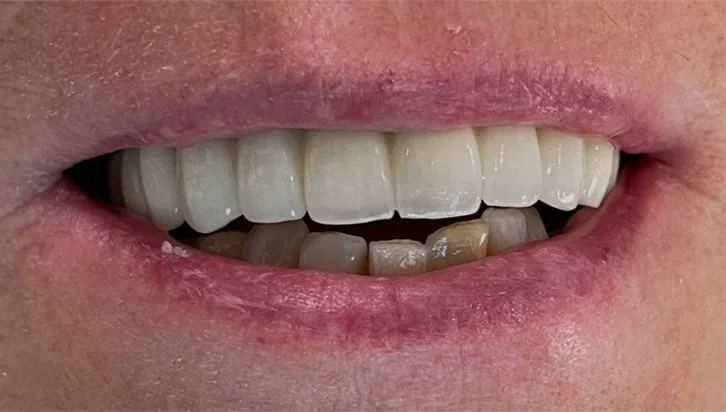 dental-implant-cases-1-before