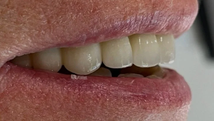 dental-implant-cases-1