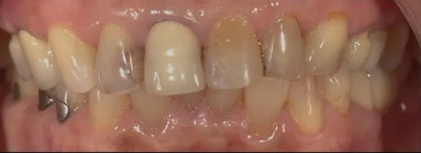 case-10 after