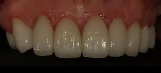 case-11 after