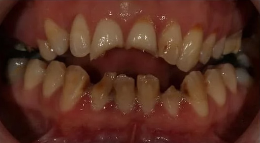 case-11 before