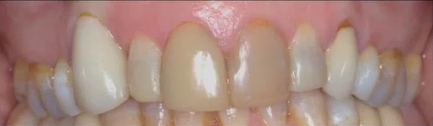case- before