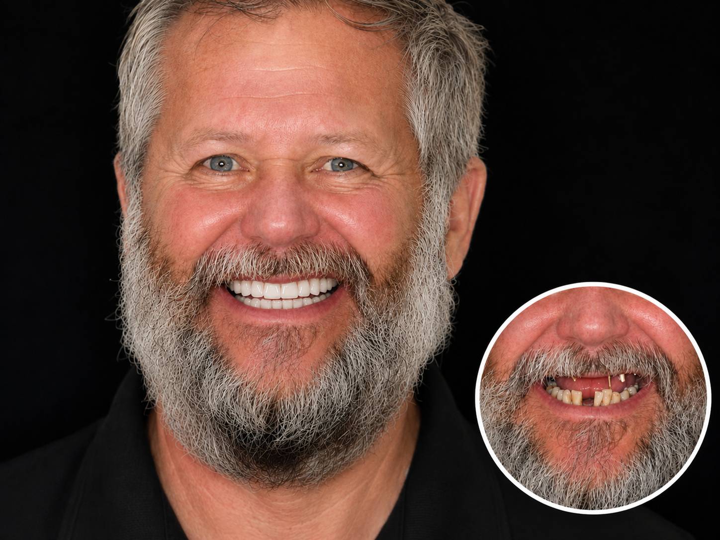 dental-implant-before-after-cases 9