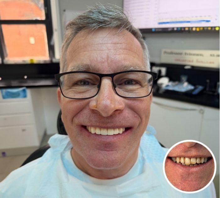 dental implant before after cases3