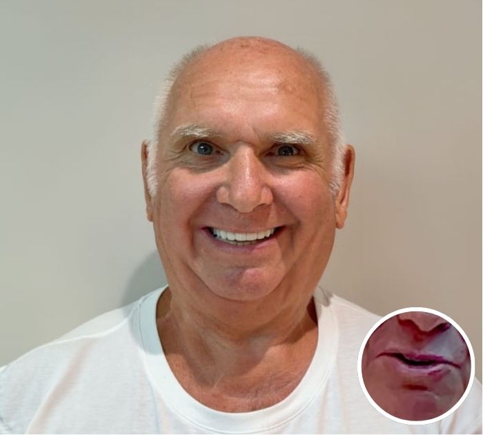 dental implant before after cases4