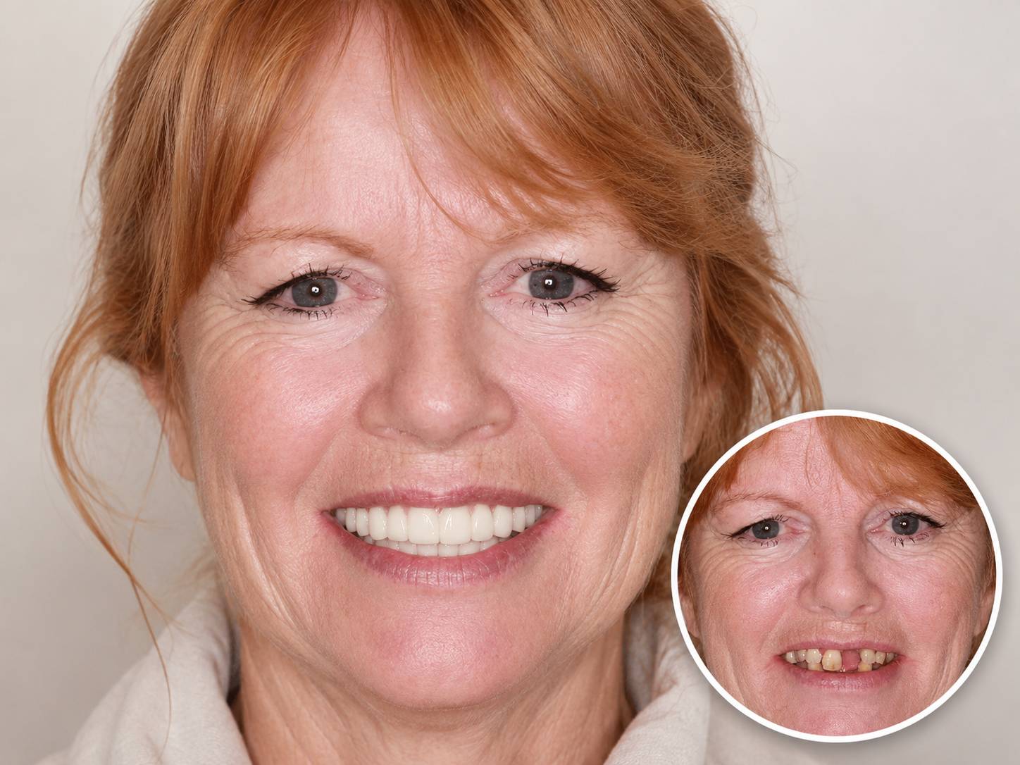 dental-implant-before-after-cases6