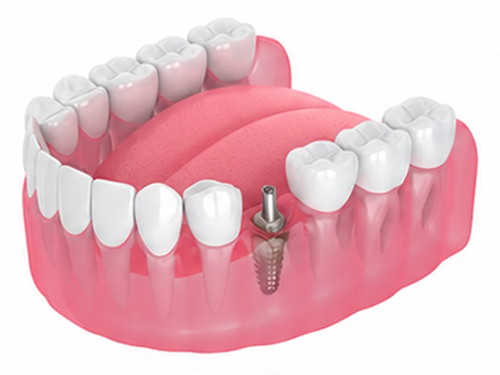 failed-implant-img