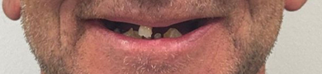 implant-dic-before-case-2
