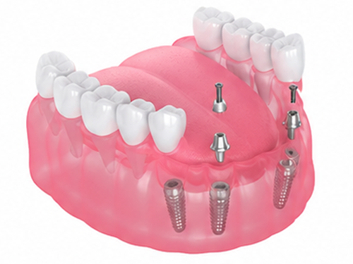 supervised-implant-placement-img
